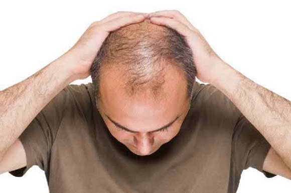 AGAの治療で引き起こされる初期脱毛の特徴とは？